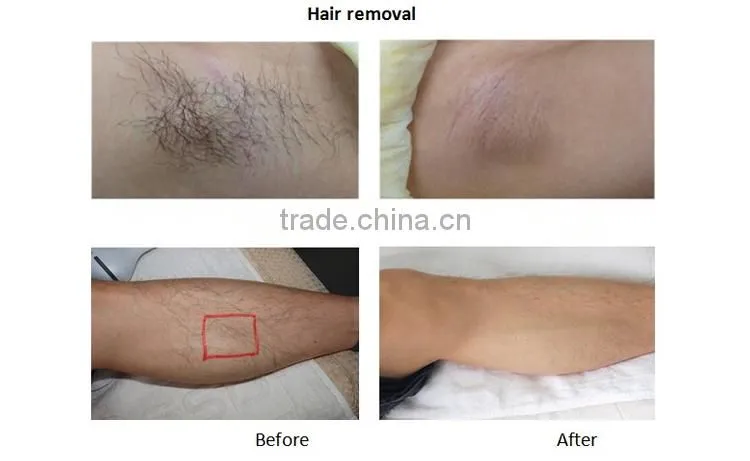 DEESS IPL laser permanent hair removal at home with replaceable lamp