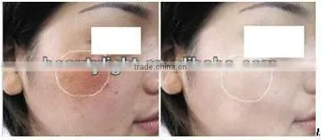 Newest Pigmentation Killerbattery tattoo beauty machine