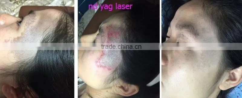 Vietnam distributor Cheap Yes Q-Switch and Laser Type q switched nd yag laser tattoo removal machine