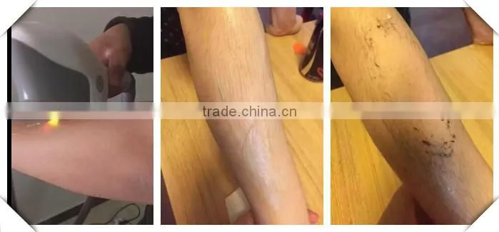 best machine wholesale price new design ipl shr hair removal laser