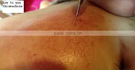 Nubway portable machine removal spider vein best system vein view