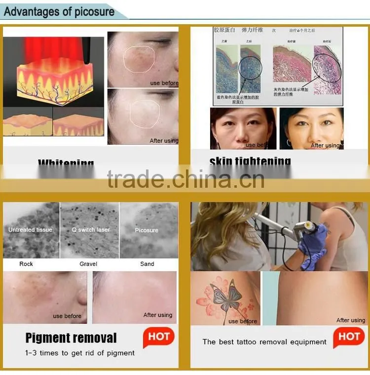 Q-Switch and Imported gems Q-switch ND yag Laser,Laser Type 1064 532nm nd yag laser