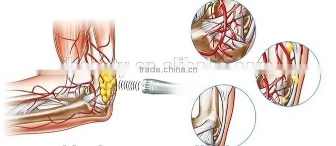 2016 new Physiotherapy extracorporeal shoulder pain therapy equipment shockwave machine