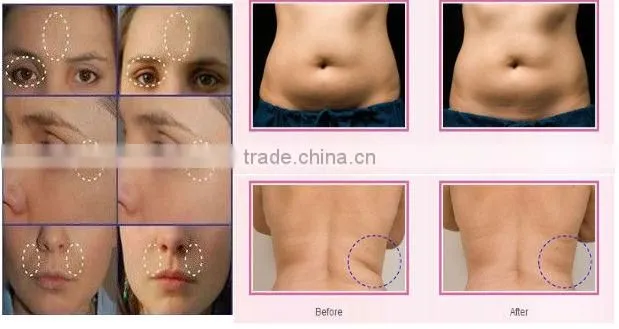 professional rf face lifting machine