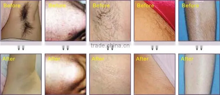 Popular 808nm diode laser hair removal machine price