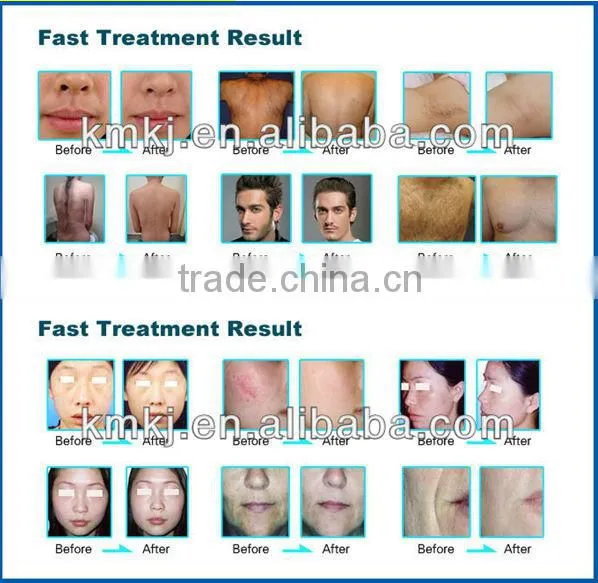 promotion hair removal skin care 2in1 ipl rf machine(CE ISO TUV BV)