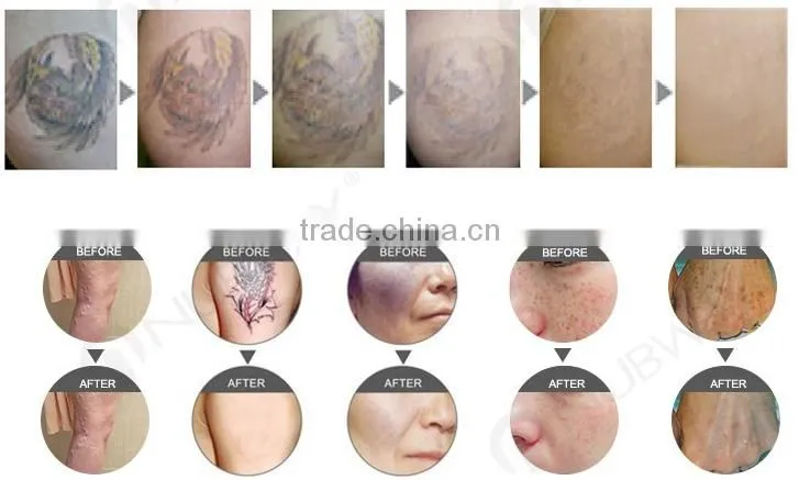 1064/532nm beauty equipment yellow/blue/red tattoo removal nd yag laser