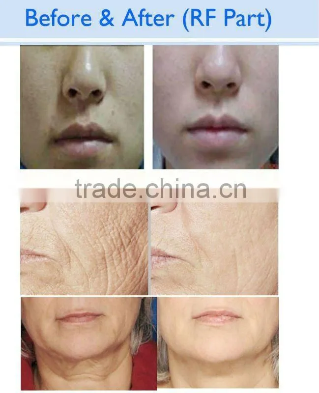 Hot in 2014 !! Tattoo and Hair Removal E light ipl rf nd yag laser (CE-Approve)