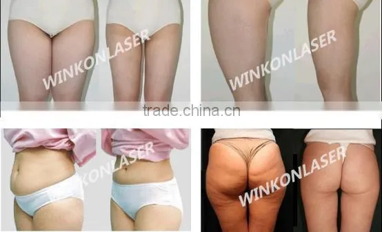 lipo lovely laser light / laser machine for weight loss / lipo laser for sale