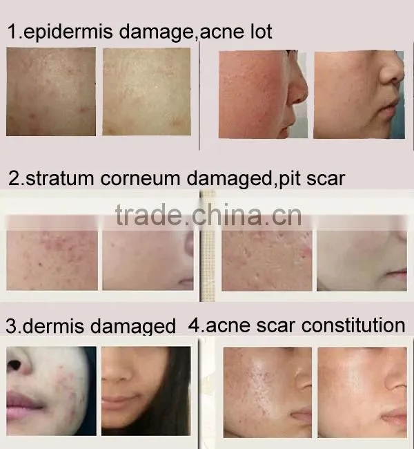 Titanium 192 Needles. Wrinkles, Acne, Derma Roller To Improve Skin Elasticity