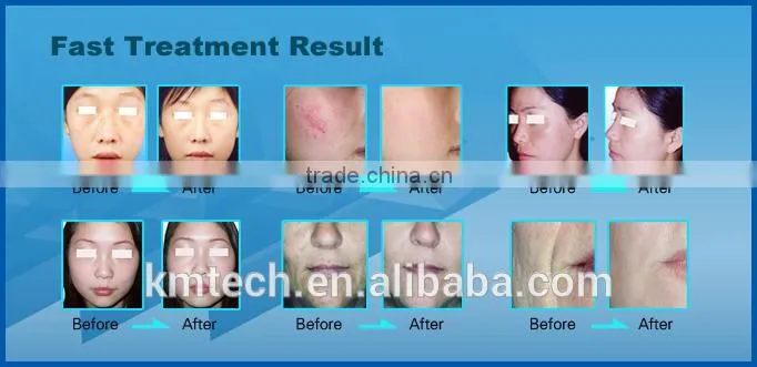 Hot selling hair removal machines for beauty with CE/ISO/BV/TUVcertificate