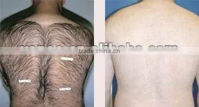 Hot Sale in 2014 IPL&RF hair removal machine