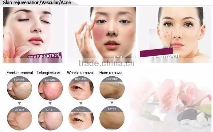 KEYLASER hair removal ipl opt wrinkle removal ipl depilator