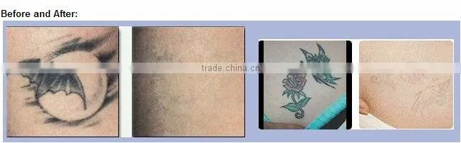 Portable Tattoo Removal Q-switched Nd Yag laser