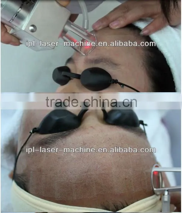RF skin tightening machine skin whitening products best face lifting machine