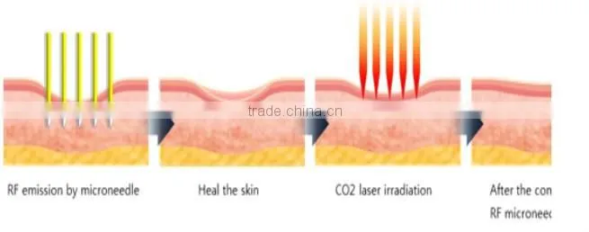 Face lifting machine fractional RF microneedle facial machine aesthetic equipment