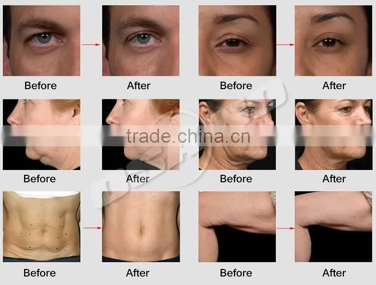 RF facial machine , ultra lipo cavitation rf beauty slimming machine