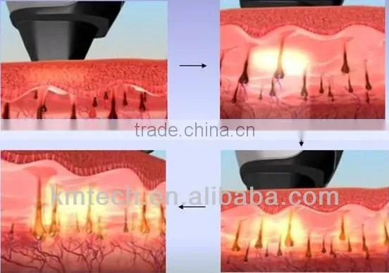 Best fda approved laser hair removal machine for sale