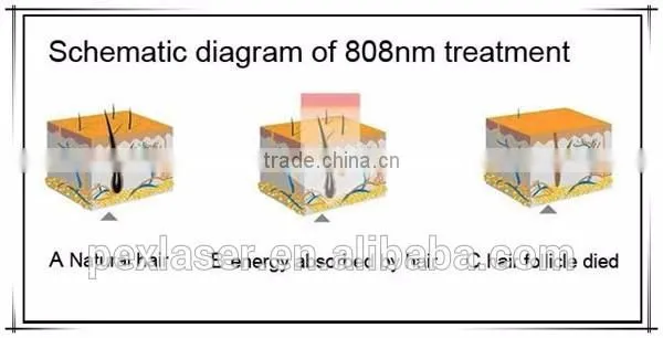 Portable diode laser hair removal equipment 808nm diode laser