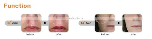 G-49 acne treatment scar removal pen for skin care
