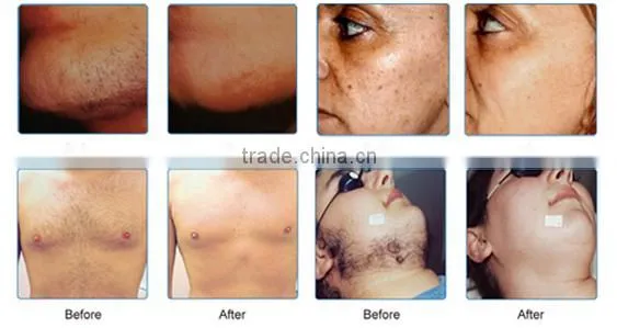 Factory price outlet opt ipl hair removal machine pain free
