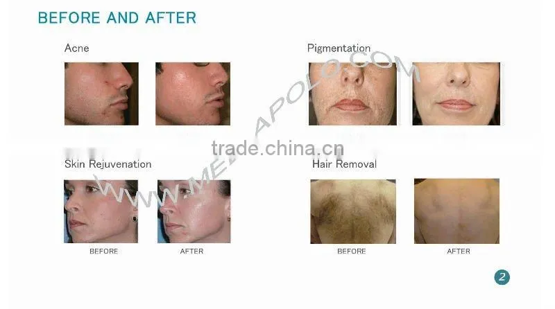 ipl wrinkle remover freckle removing machine better than cream HS-300E by shanghai med apolo medical technology