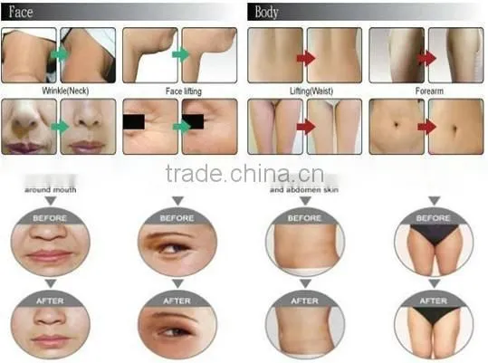 IPL Hair Removal Skin Rejuvenation Equipment/Beauty Salon IPL salon Machine