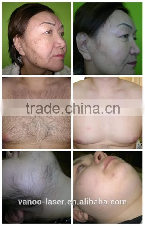 2015 new arrival ipl photo rejuvenation machine