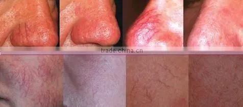 factory price best beauty device / facial veins removal / varicose vein treatment equipment