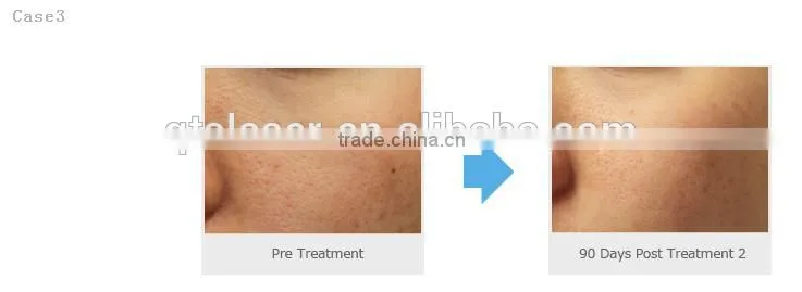 Hot product!! Meso Guns for non- surgical skin careness with multiple micro needles