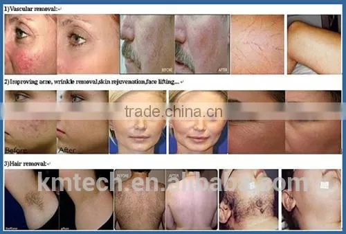 Top sale !! portable ipl /e-light machine with CE ISO13485