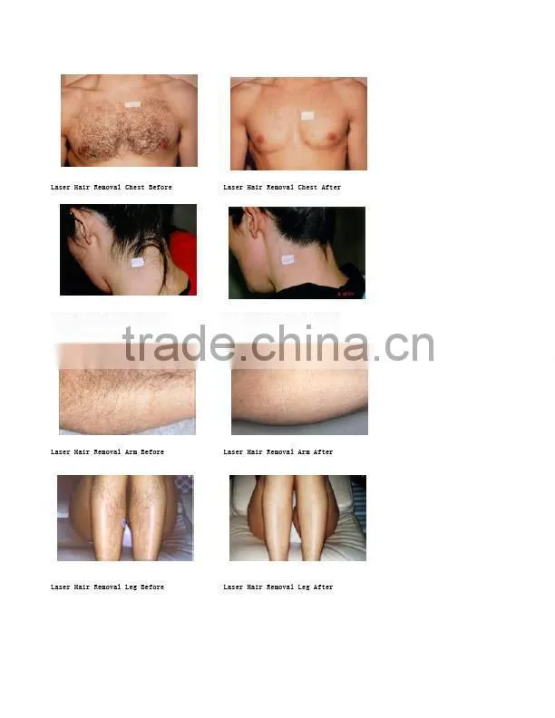 beauty salon equipment laser 808 diode hair removal DH 03N