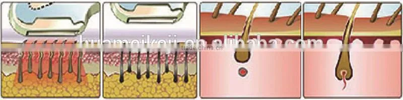 2015 Vertical vascular therapy machine intense pulsed light