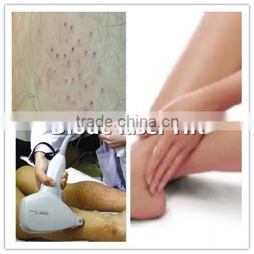 Professional Cosmetic Elight Skin Rejuvenation plus 808nm Diode Laser beauty equipment