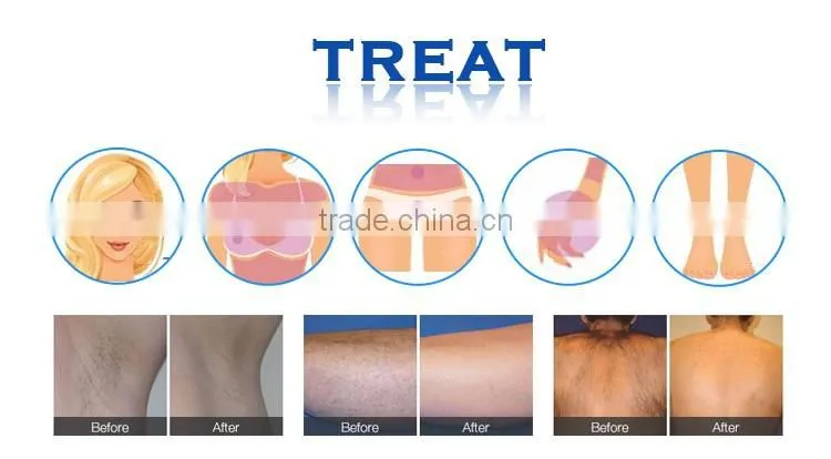 Merry christmas! Korea Portable home use ipl hair removal machine
