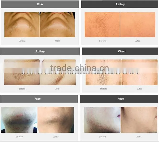 China Beauty machine diode laser hair removal laser skin rejuvenation
