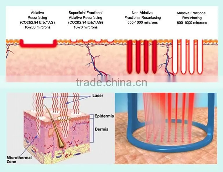 Popular Style!! Skin Rejuvenation Laser Vaginal Tightening Device CO2 Laser Fractional Machine with CE