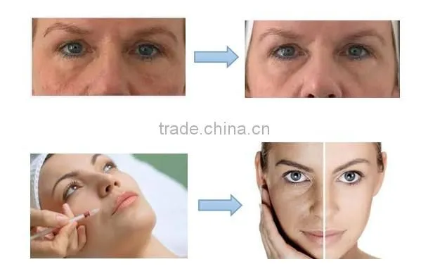 Patent PRP tube in China