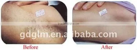 long pulse nd yag laser beauty equipment