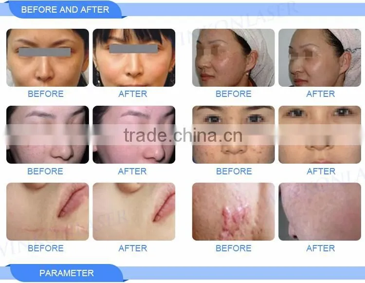 High-tech 10inch touch screen long time use RF beauty equipment co2 fractional laser vaginal tightening