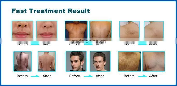 Portable cheap 100,000 shots flash ipl laser facial rejuvenation machine