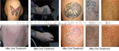 2015 New Design Q-Switch Laser Tattoo Removal Laser