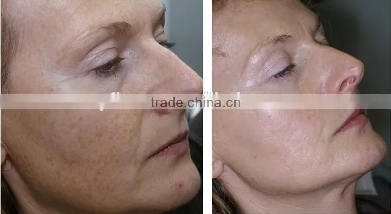 Natural skin care oxygen therapy machine