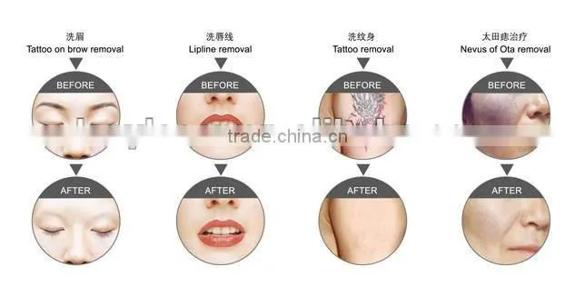 YAG+IPL+RF multifuntion Beauty Machine for spa salon