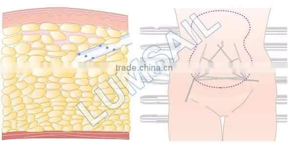 Plastic surgery Power Assisted Surgical liposuction equipment for Plastic surgery