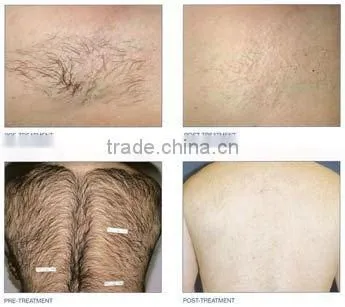 diode laser depilation beauty machine with comfortable feeling -A009