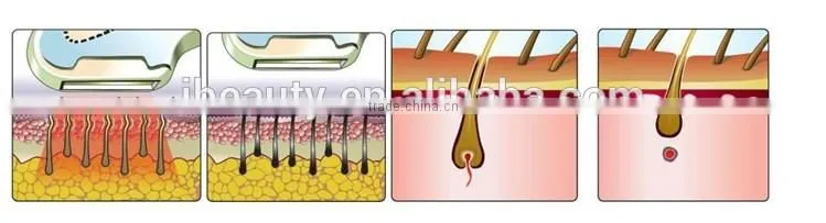 Wholesale low price high quality ipl shr laser