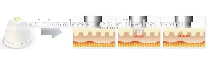fractional rf / rf fractional micro needle / rf skin tightening machine