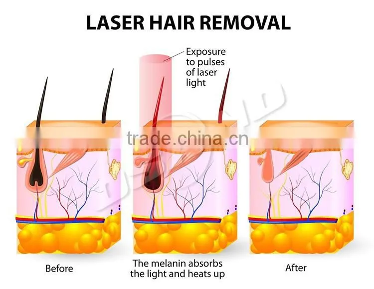 Popular Laser Therapy Laser Hair Remocal Permanent Salon Equipment