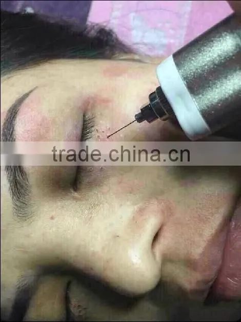 Micro Portable Handhold freckles removal pen